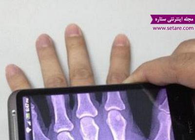 تکنولوژی جدید موبایل برای دریافت عکس رادیولوژی