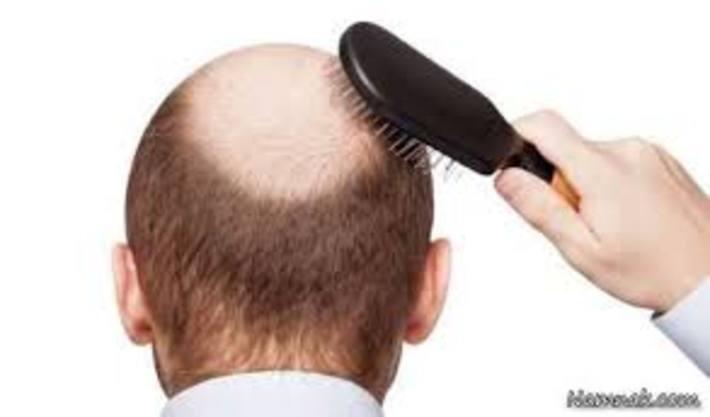 درمان طبی ریزش مو درمان طبی ریزش مو